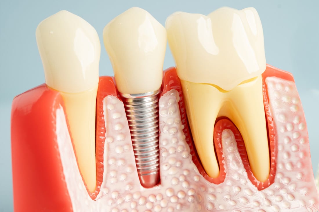 Zahnimplantate Grafik